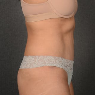 Tummy Tuck Before & After Gallery - Patient 569395 - Image 6