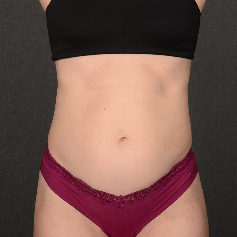 Tummy Tuck Before & After Gallery - Patient 372131 - Image 1