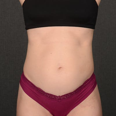 Tummy Tuck Before & After Gallery - Patient 372131 - Image 1