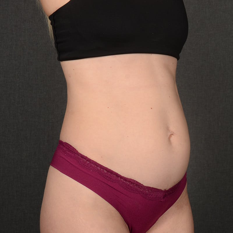 Tummy Tuck Before & After Gallery - Patient 372131 - Image 3