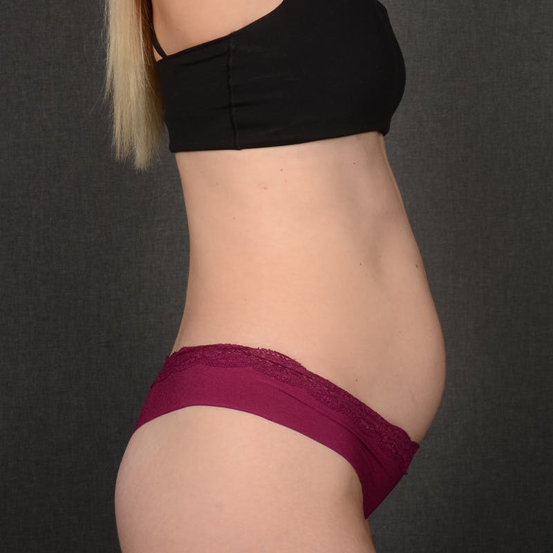 Tummy Tuck Before & After Gallery - Patient 372131 - Image 5