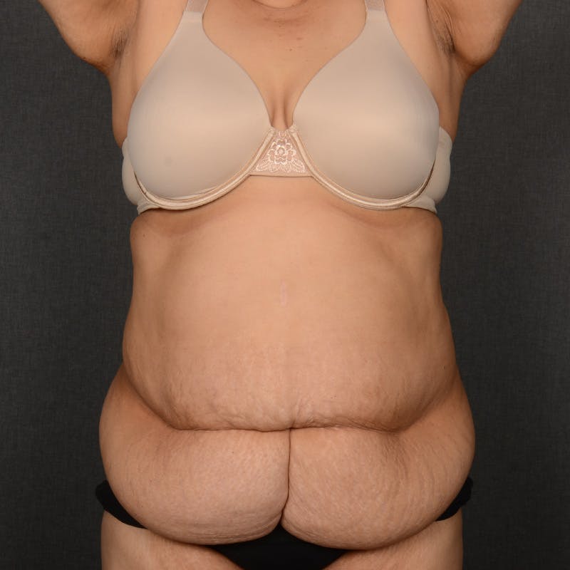 Tummy Tuck Before & After Gallery - Patient 297357 - Image 1