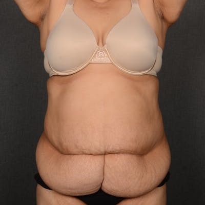 Tummy Tuck Before & After Gallery - Patient 297357 - Image 1