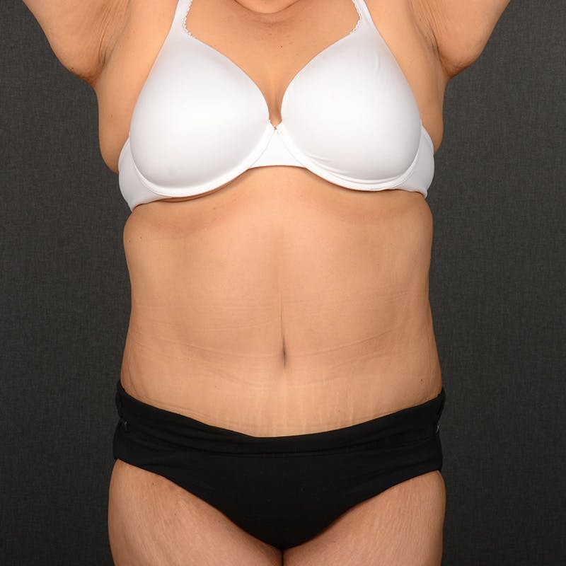 Tummy Tuck Before & After Gallery - Patient 297357 - Image 2