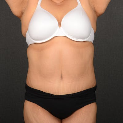 Tummy Tuck Before & After Gallery - Patient 297357 - Image 2