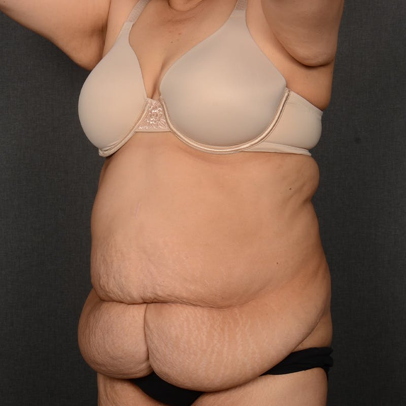 Tummy Tuck Before & After Gallery - Patient 297357 - Image 3