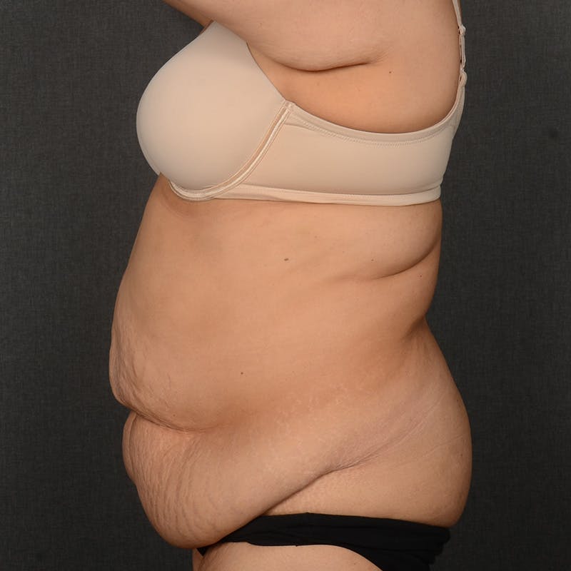 Tummy Tuck Before & After Gallery - Patient 297357 - Image 5