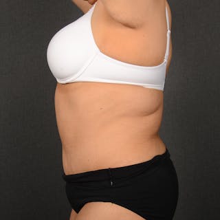 Tummy Tuck Before & After Gallery - Patient 297357 - Image 6