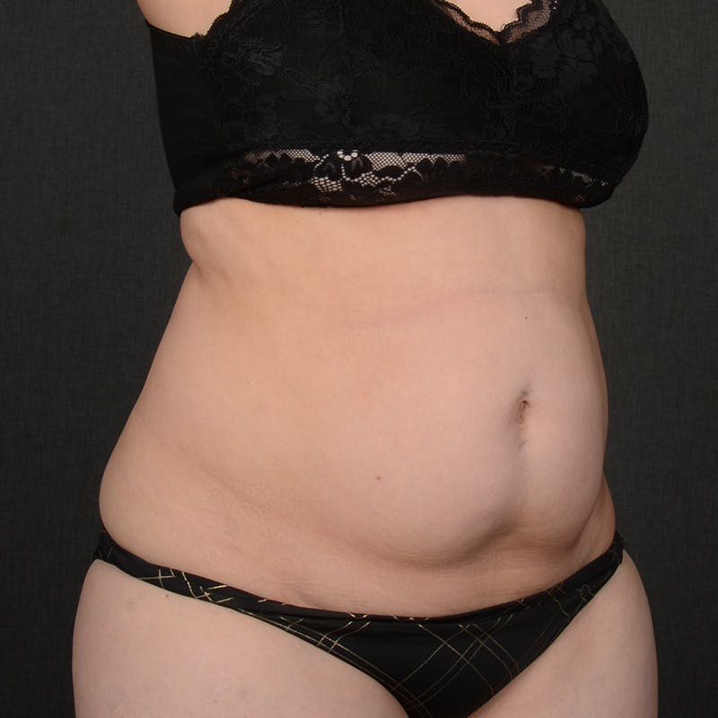 Tummy Tuck Before & After Gallery - Patient 144332 - Image 3