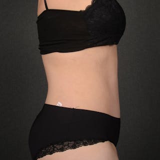 Tummy Tuck Before & After Gallery - Patient 144332 - Image 6