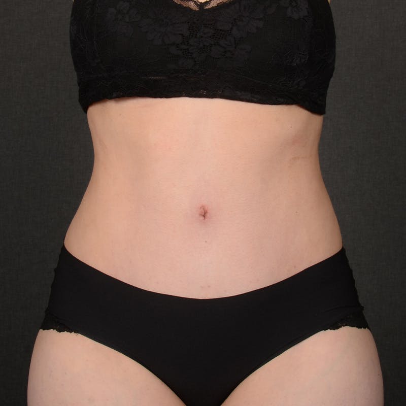 Tummy Tuck Before & After Gallery - Patient 144332 - Image 2