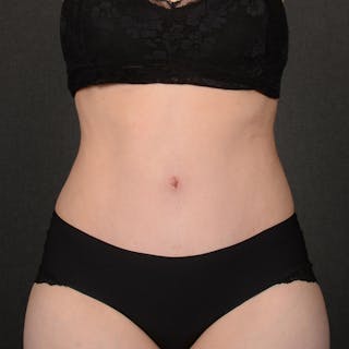 Tummy Tuck Before & After Gallery - Patient 144332 - Image 2