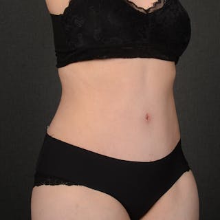Tummy Tuck Before & After Gallery - Patient 144332 - Image 4