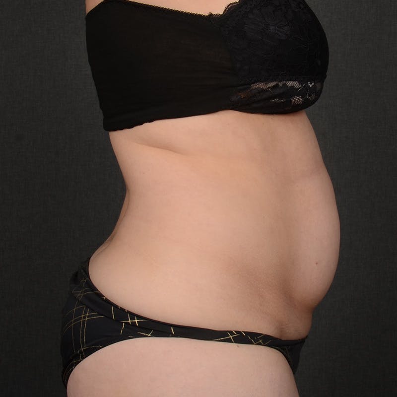 Tummy Tuck Before & After Gallery - Patient 144332 - Image 5