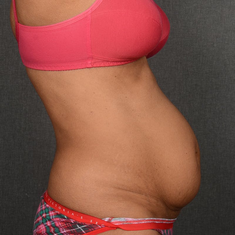 Severe Diastasis Recti Before & After Gallery - Patient 554044 - Image 5
