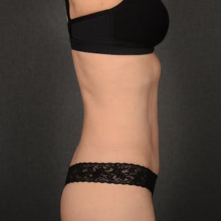 Tummy Tuck Before & After Gallery - Patient 158938 - Image 6