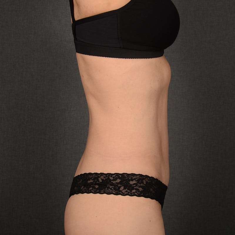 Tummy Tuck Before & After Gallery - Patient 158938 - Image 6