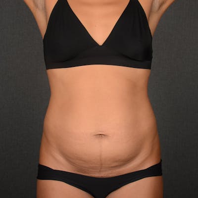 Tummy Tuck Before & After Gallery - Patient 293335 - Image 1
