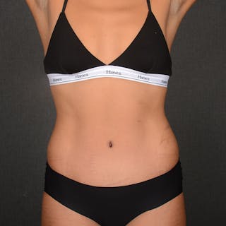 Tummy Tuck Before & After Gallery - Patient 293335 - Image 2