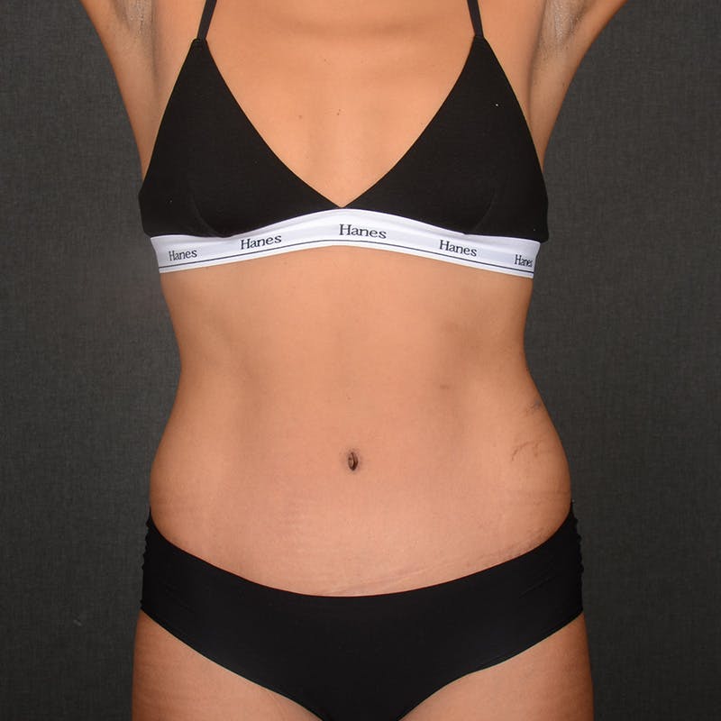 Tummy Tuck Before & After Gallery - Patient 293335 - Image 2