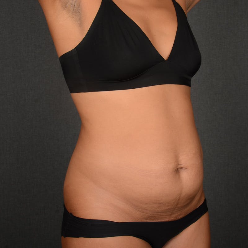 Tummy Tuck Before & After Gallery - Patient 293335 - Image 3