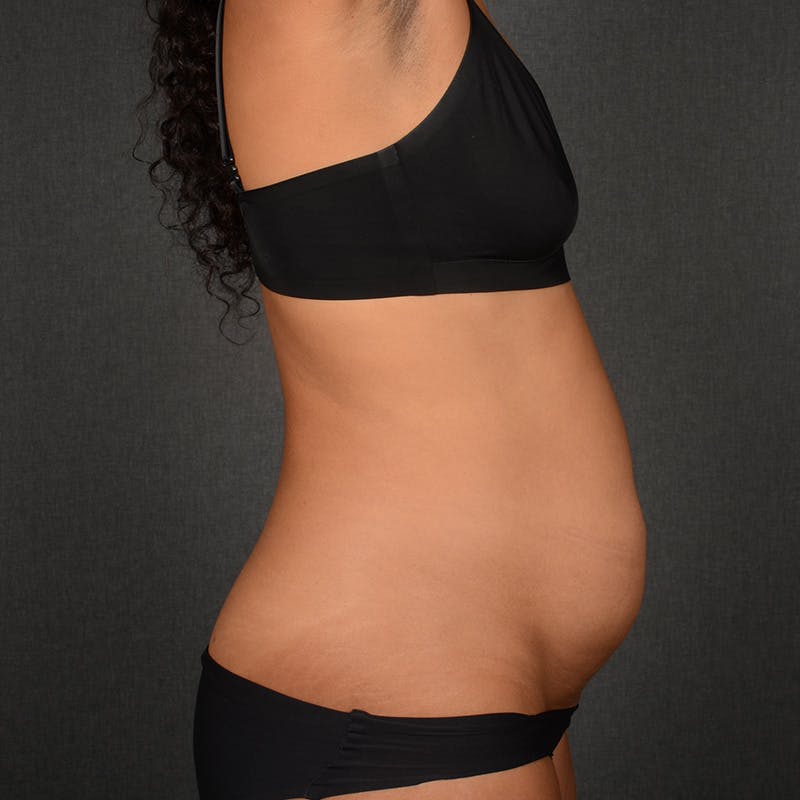 Tummy Tuck Before & After Gallery - Patient 293335 - Image 5