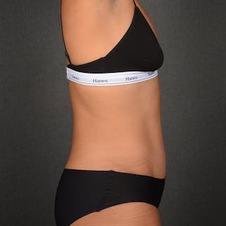 Tummy Tuck Before & After Gallery - Patient 293335 - Image 6