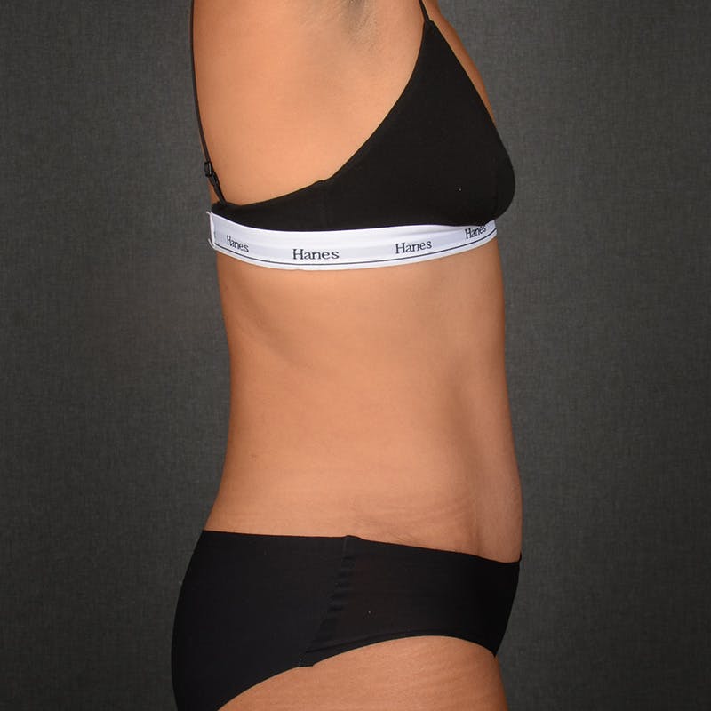 Tummy Tuck Before & After Gallery - Patient 293335 - Image 6