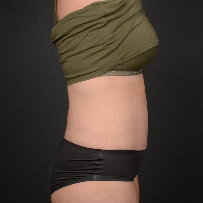 Tummy Tuck Before & After Gallery - Patient 809412 - Image 6