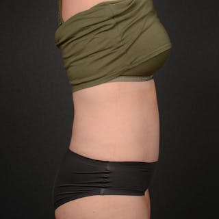 Tummy Tuck Before & After Gallery - Patient 809412 - Image 6
