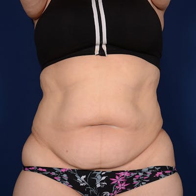 Tummy Tuck Before & After Gallery - Patient 847076 - Image 1