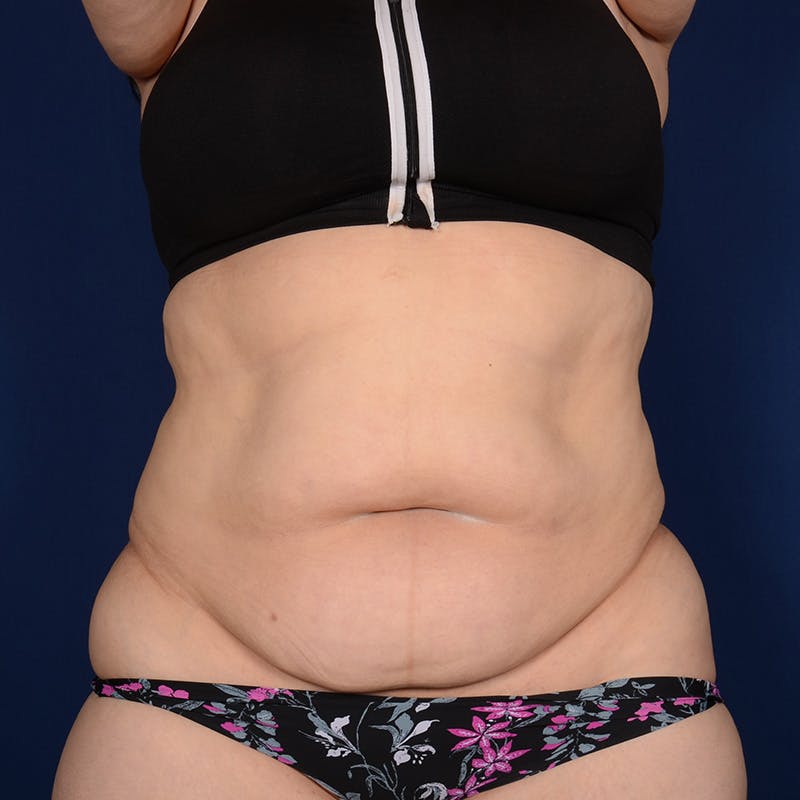 Tummy Tuck Before & After Gallery - Patient 847076 - Image 1