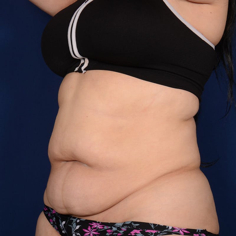 Tummy Tuck Before & After Gallery - Patient 847076 - Image 3