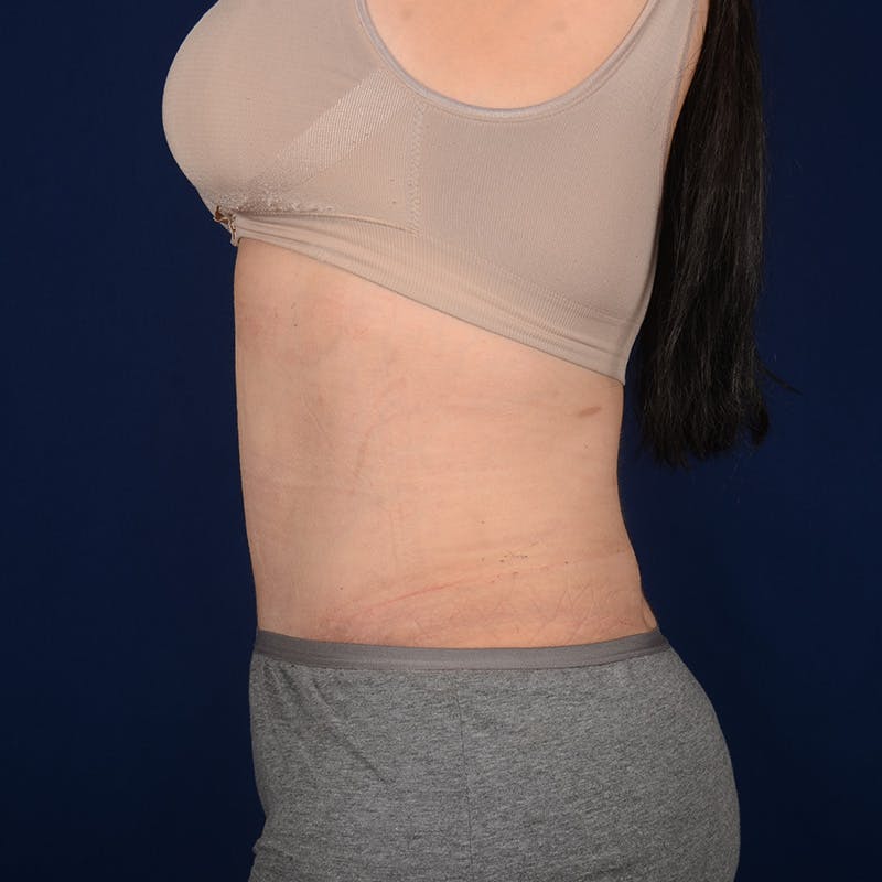 Tummy Tuck Before & After Gallery - Patient 847076 - Image 6