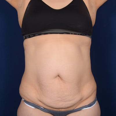 Tummy Tuck Before & After Gallery - Patient 422180 - Image 1