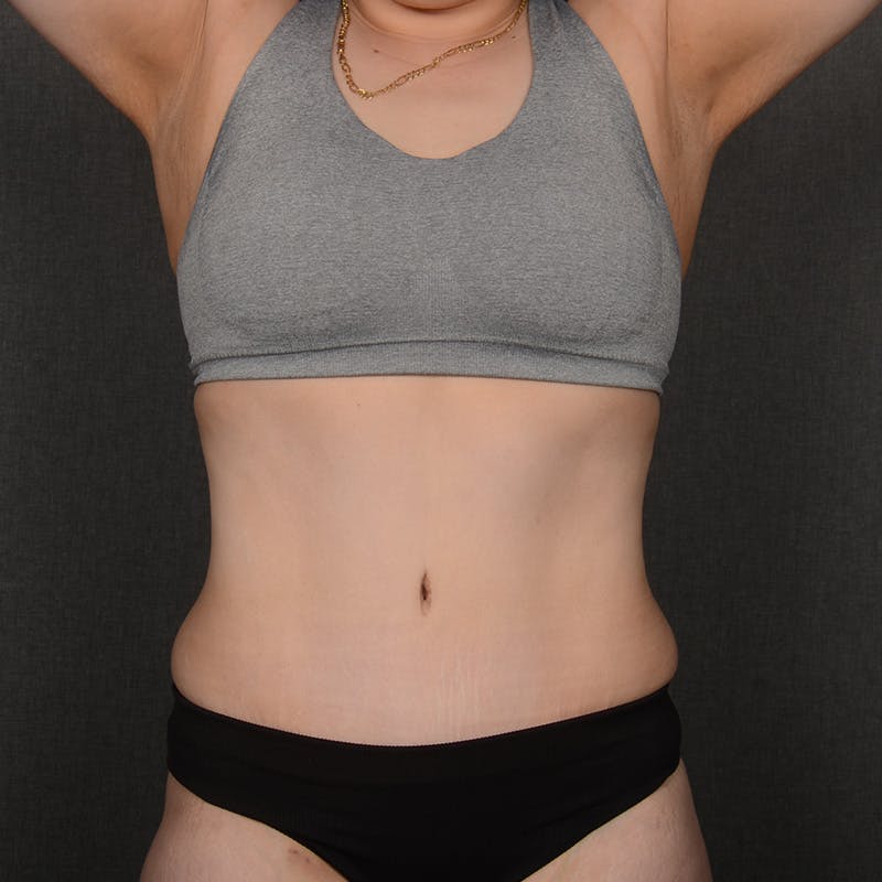 Tummy Tuck Before & After Gallery - Patient 422180 - Image 2