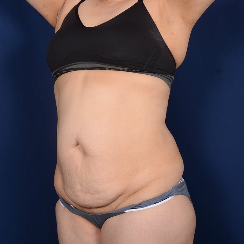 Tummy Tuck Before & After Gallery - Patient 422180 - Image 3