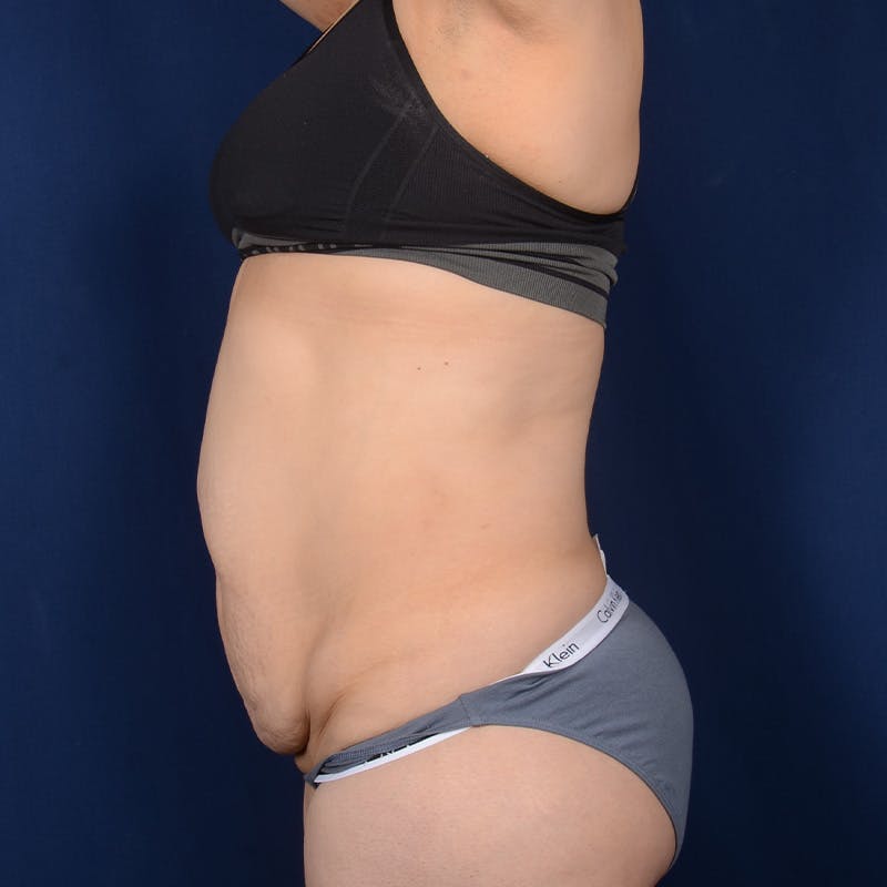 Tummy Tuck Before & After Gallery - Patient 422180 - Image 5