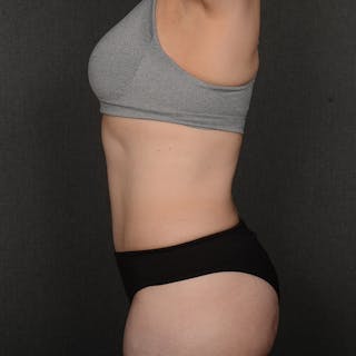 Tummy Tuck Before & After Gallery - Patient 422180 - Image 6