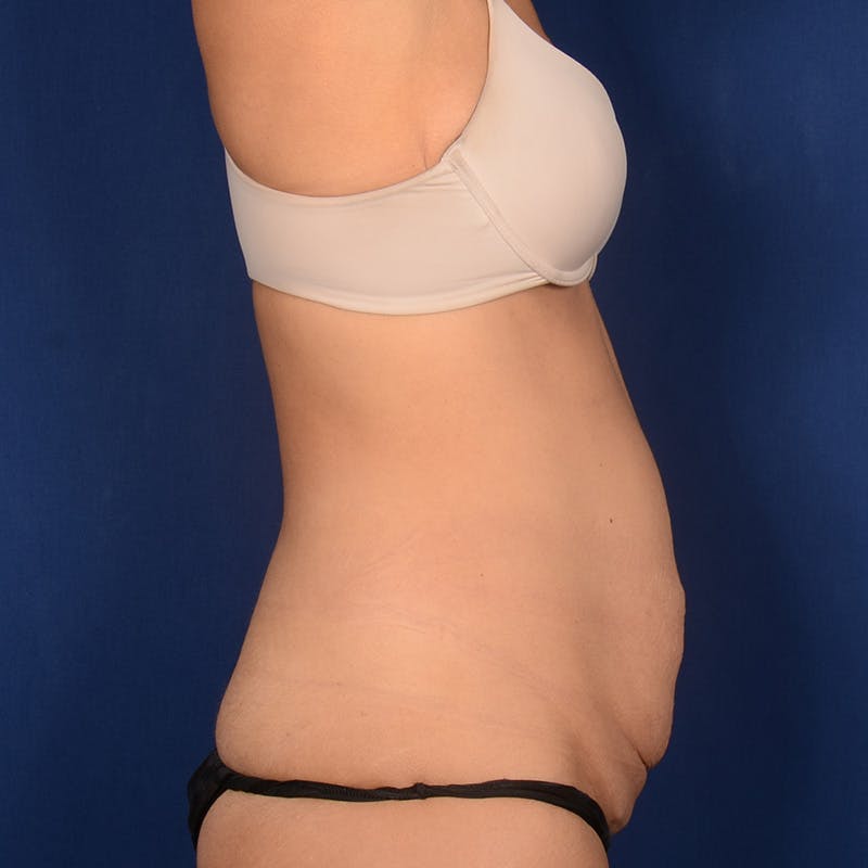 Tummy Tuck Before & After Gallery - Patient 127407 - Image 5