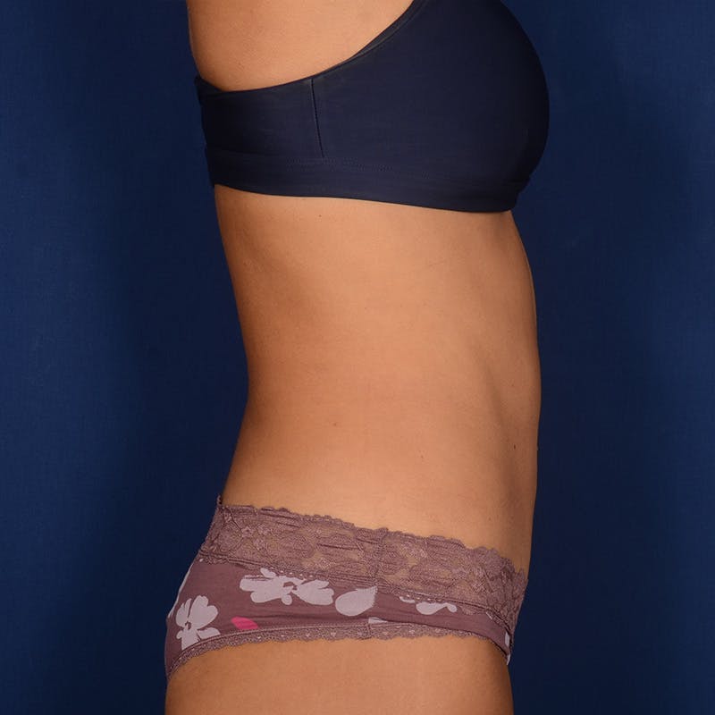 Tummy Tuck Before & After Gallery - Patient 127407 - Image 6