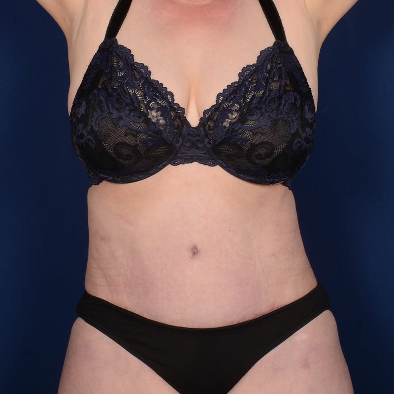 Tummy Tuck Before & After Gallery - Patient 324521 - Image 2