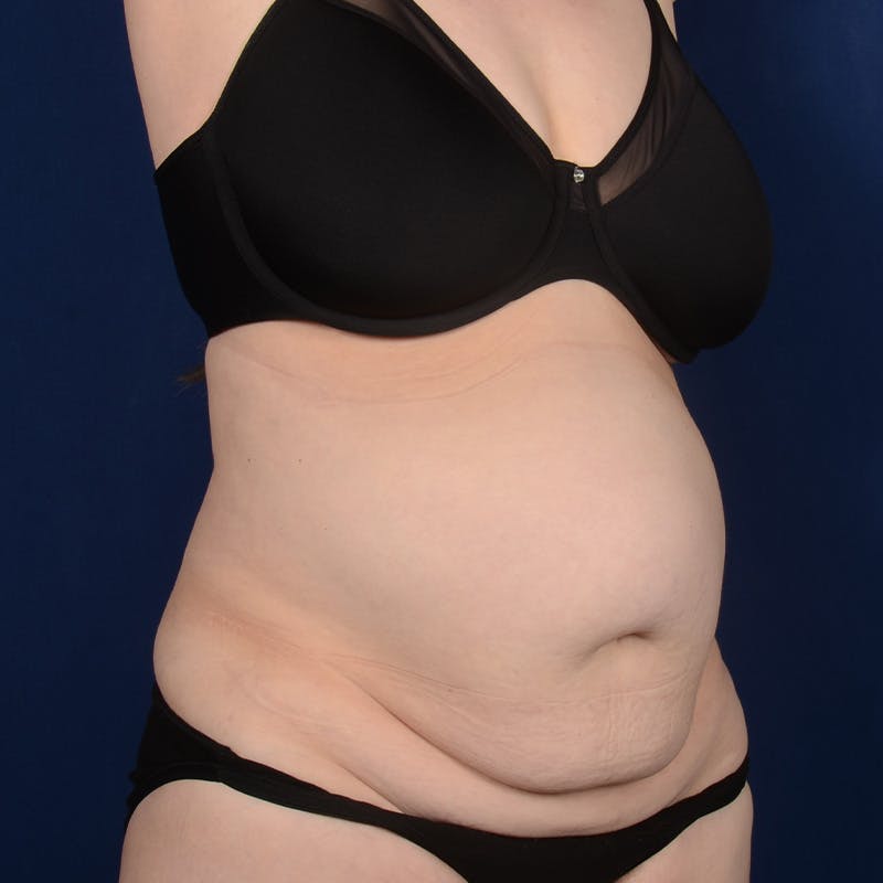 Tummy Tuck Before & After Gallery - Patient 324521 - Image 3