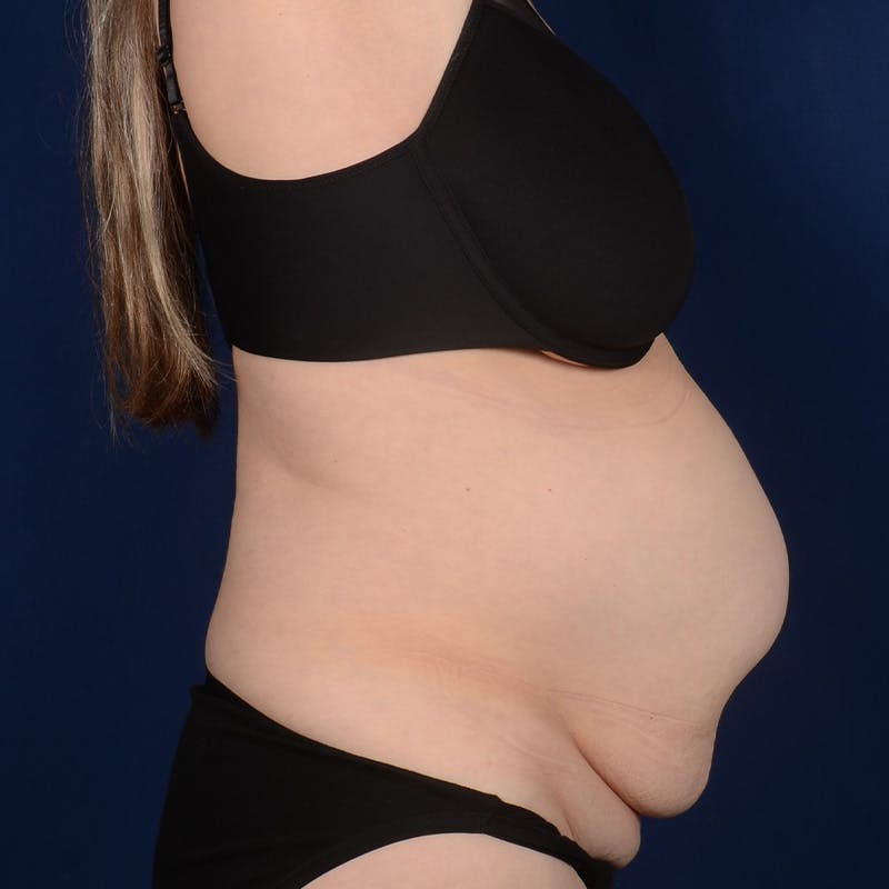 Tummy Tuck Before & After Gallery - Patient 324521 - Image 5