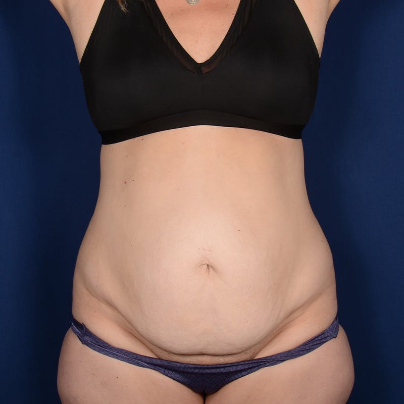 Tummy Tuck Before & After Gallery - Patient 229661 - Image 1