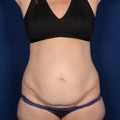 Tummy Tuck Before & After Gallery - Patient 229661 - Image 1