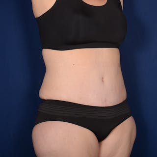 Tummy Tuck Before & After Gallery - Patient 229661 - Image 4