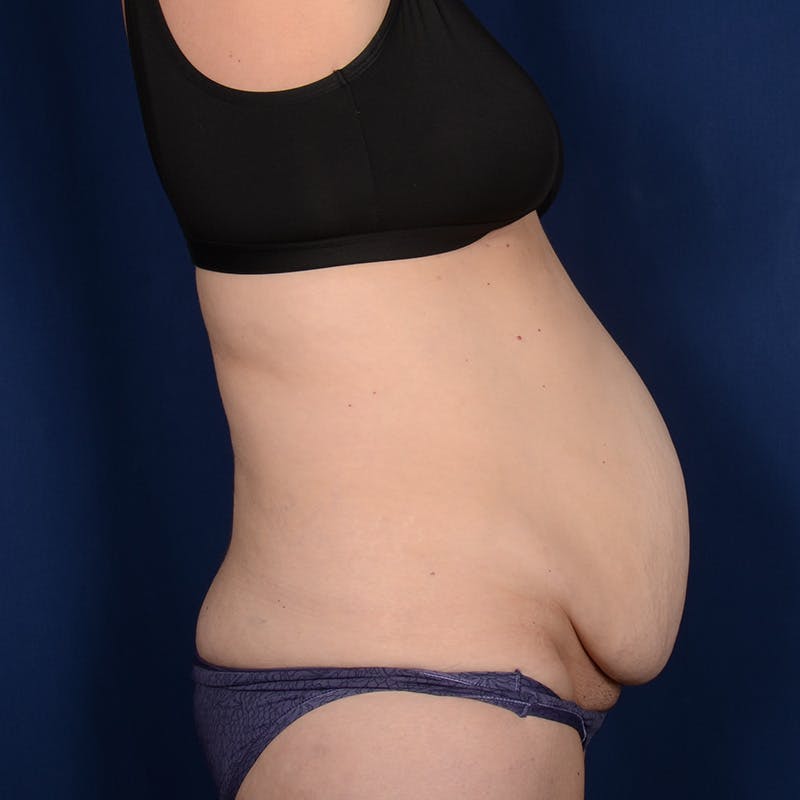 Tummy Tuck Before & After Gallery - Patient 229661 - Image 5