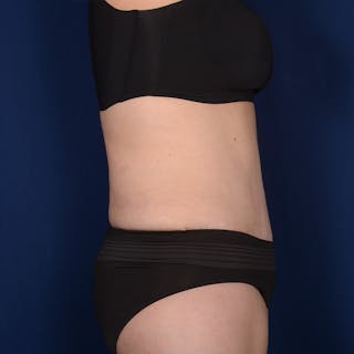 Tummy Tuck Before & After Gallery - Patient 229661 - Image 6