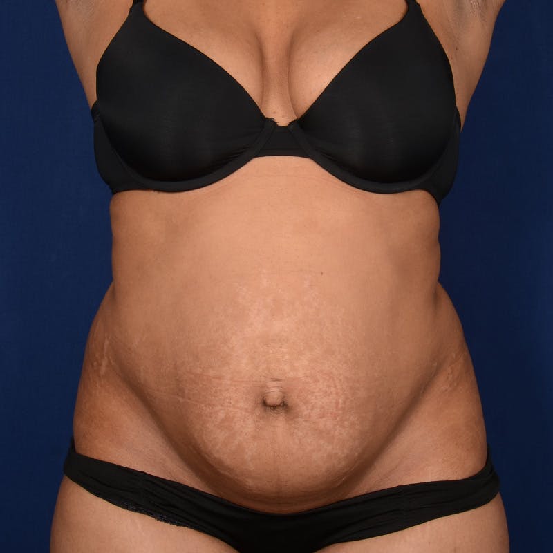 Severe Diastasis Recti Before & After Gallery - Patient 110329 - Image 1